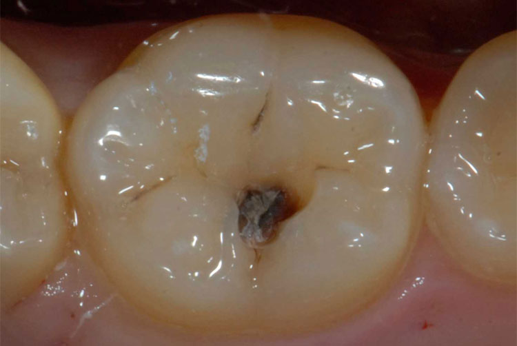 Dente Cariato
