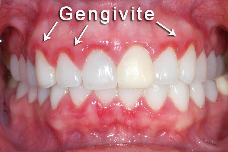 Gengivite