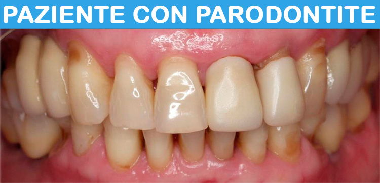 Parodontite