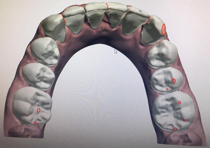 Caso ortodontico dello studio Di Poto - DOPO